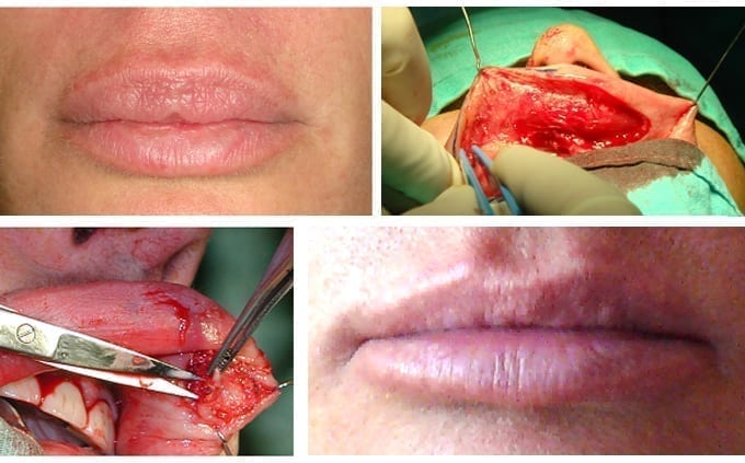 Фиг.1-4 Състояние преди и резултат след две интервенции на горната устна. Наличие на грануломи между мускулна тъкан.